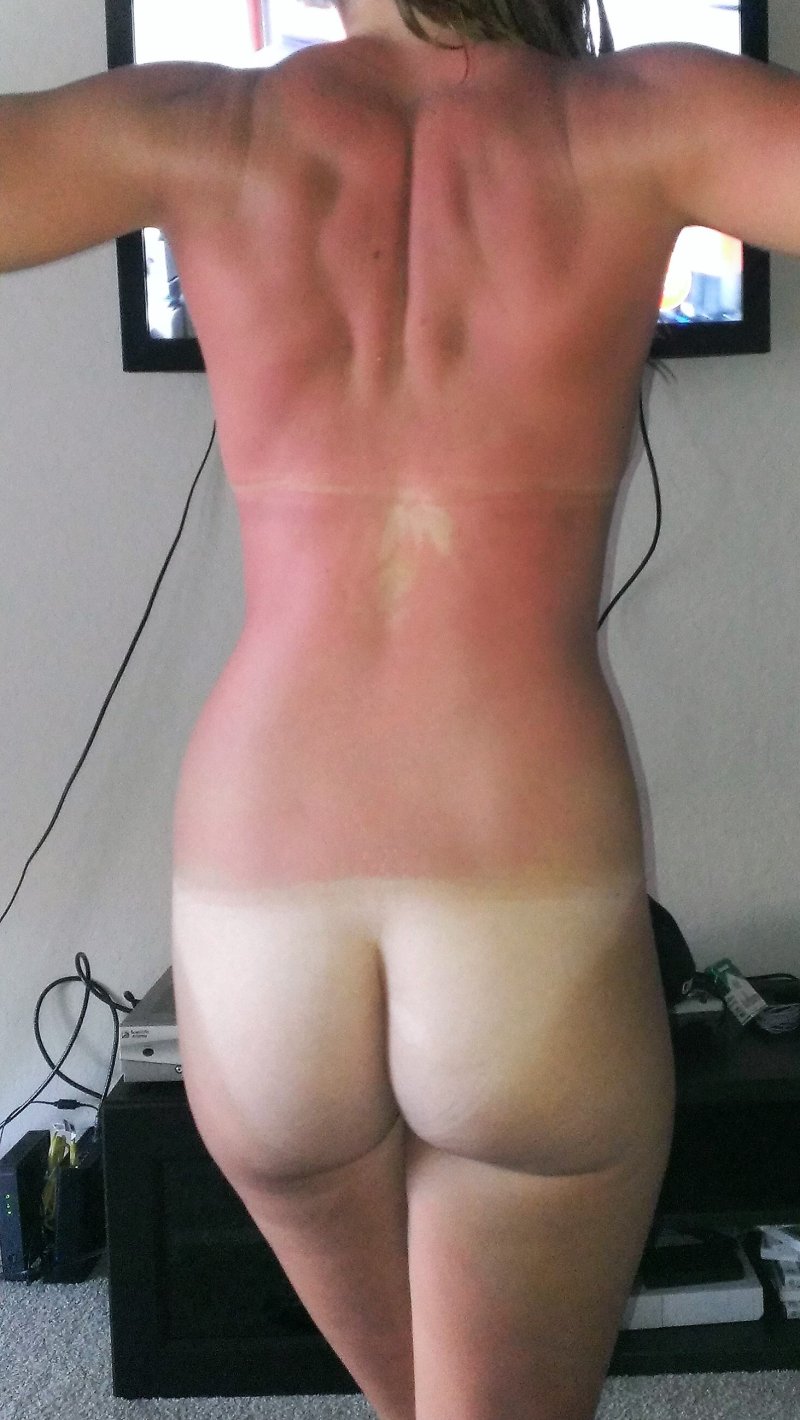 Солнечные ожоги