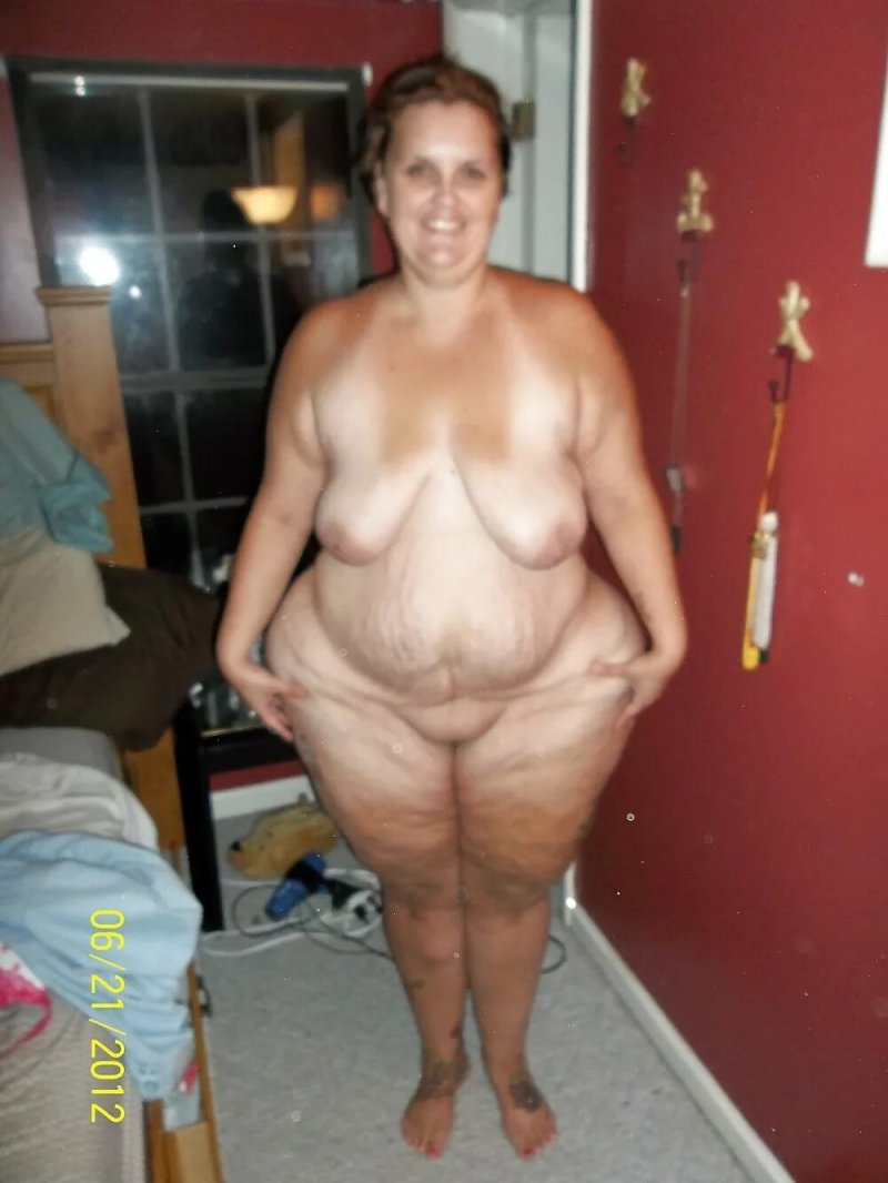 Обвисшая кожа после похудения