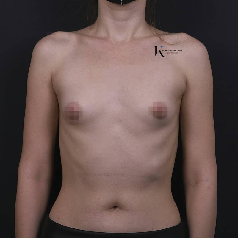 Тубулярная грудь