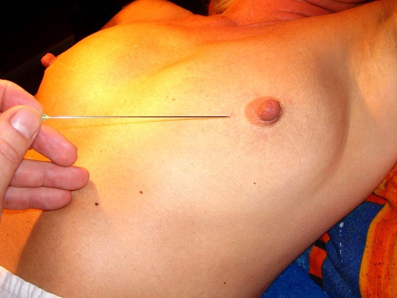 Acupuncture needle