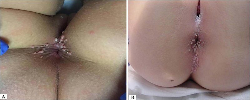 Отбеливание ануса