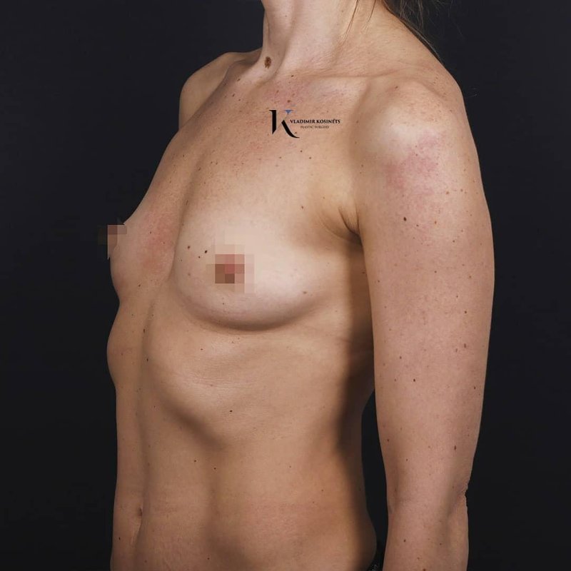 Пластика груди