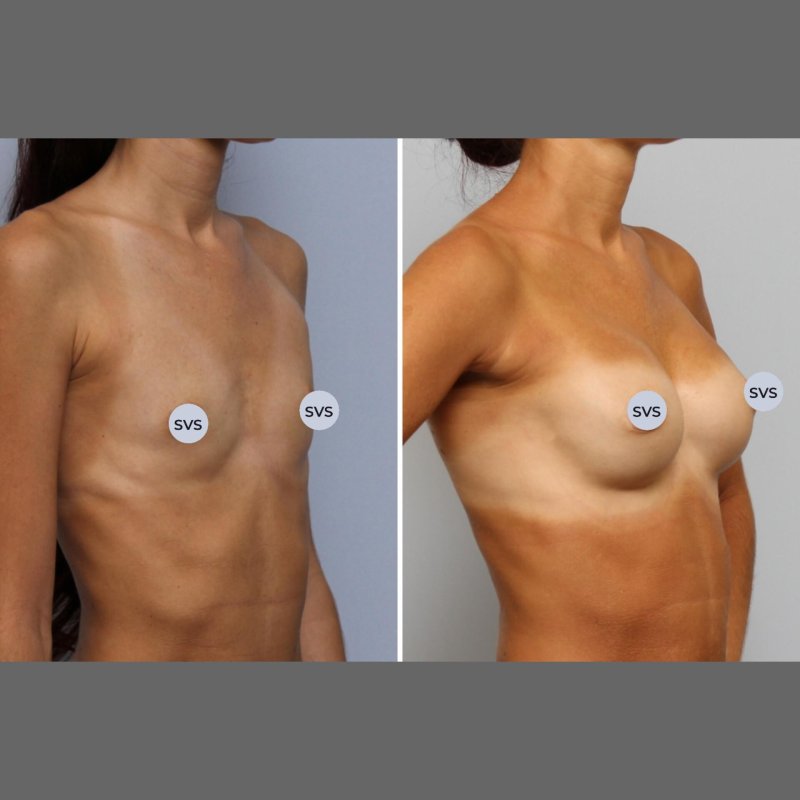 Грудь после увеличения