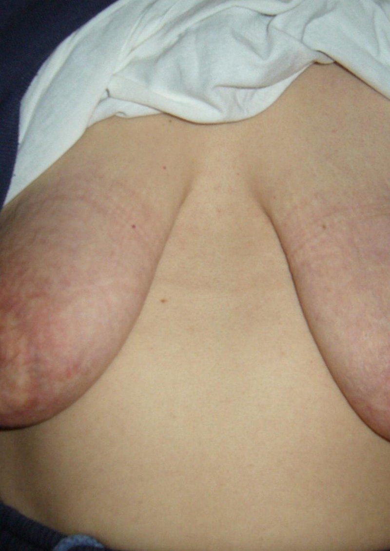 Женщины с удаленной грудью