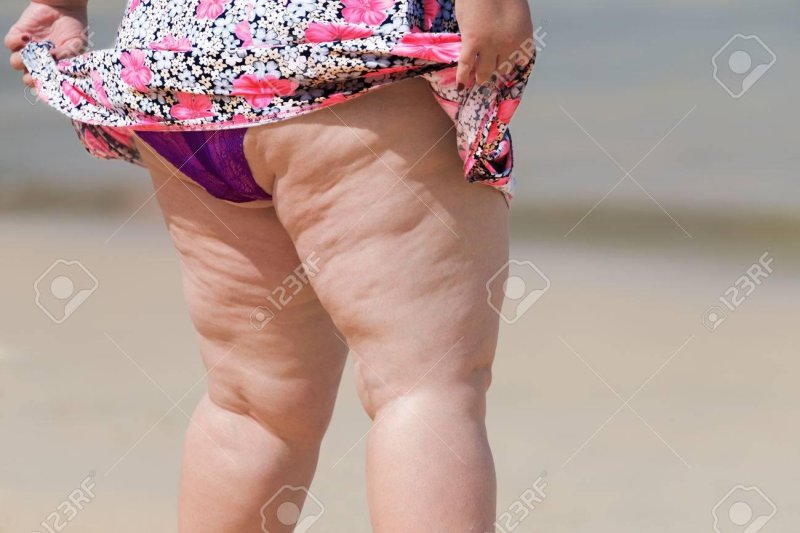 Женщина с целлюлитом