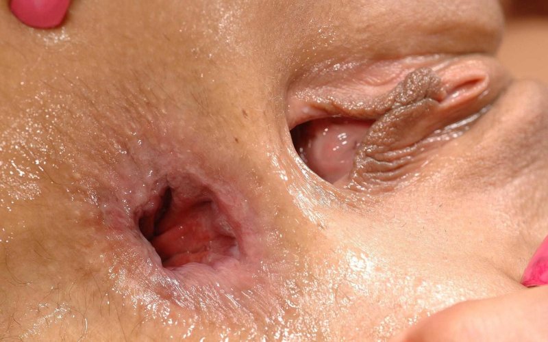 Папиллома влагалища