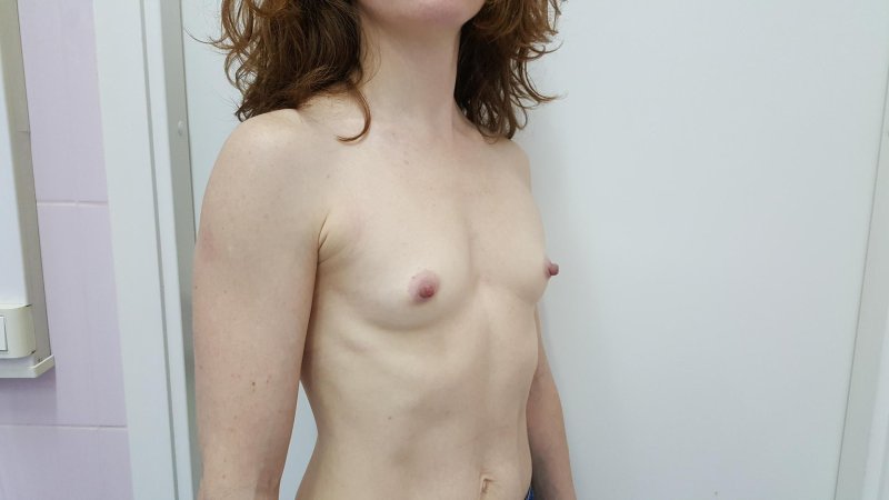 Воронкообразная деформация грудной клетки