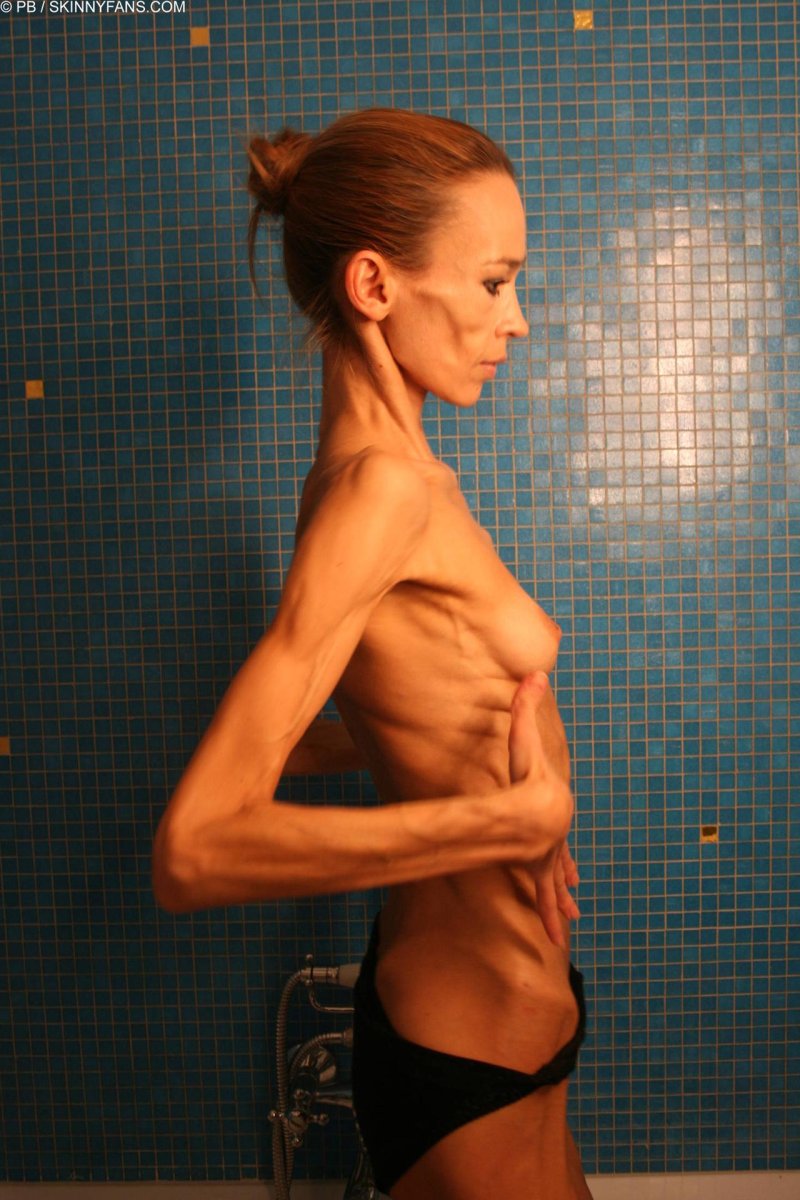 Анорексичная кахексия