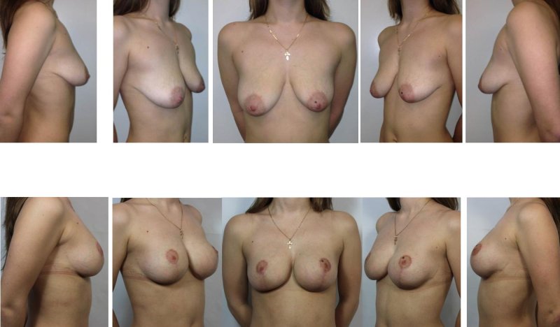 Каплевидная грудь