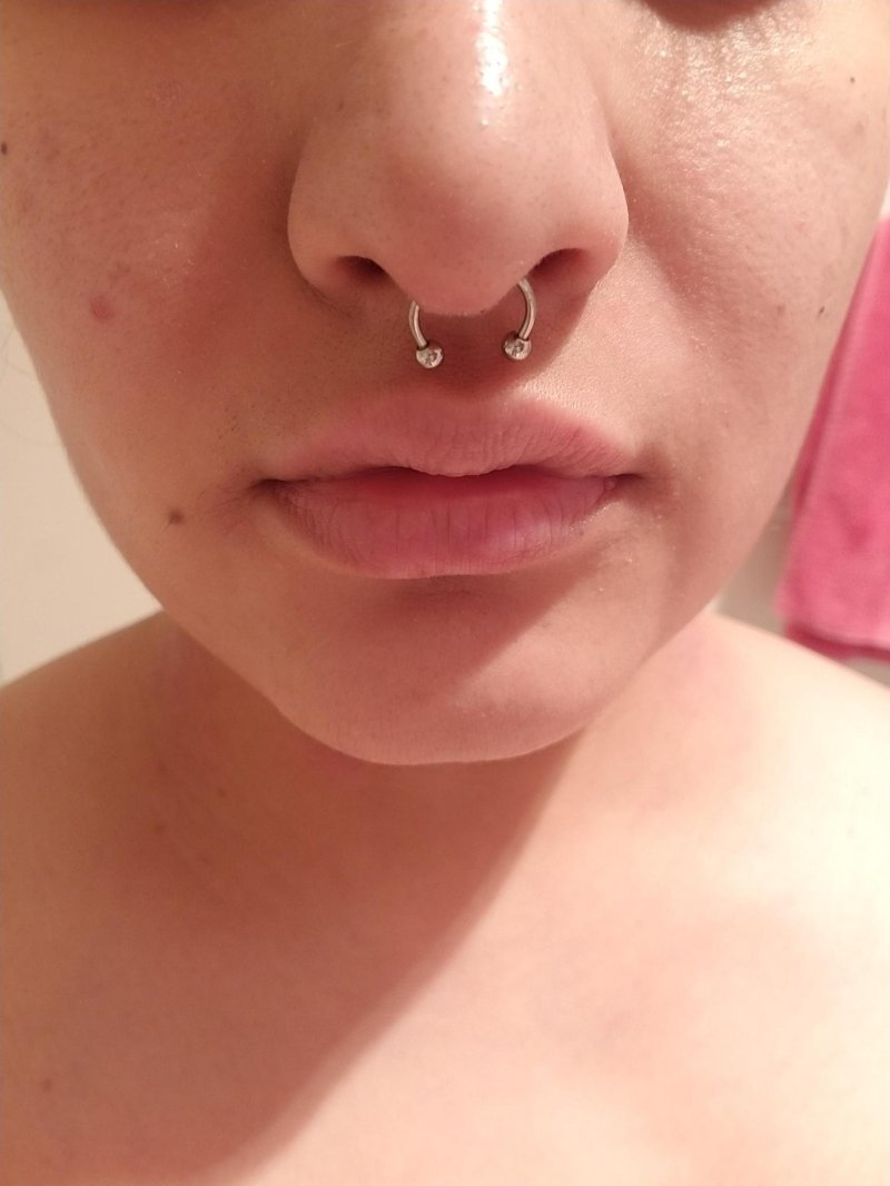 Гранулема септум