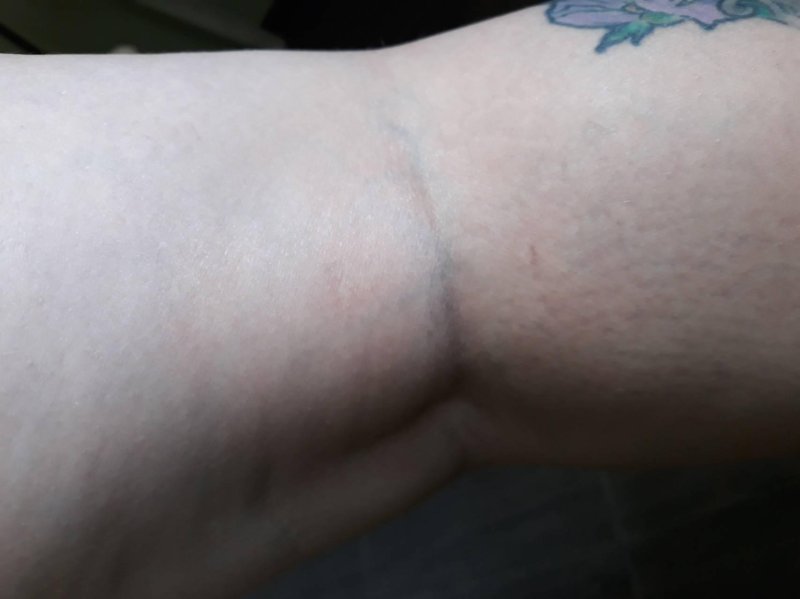 Вздулась вена