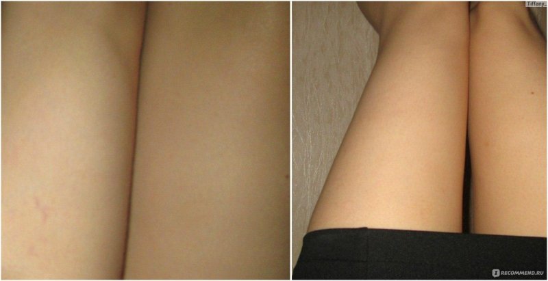 Венозная сеточка на ногах