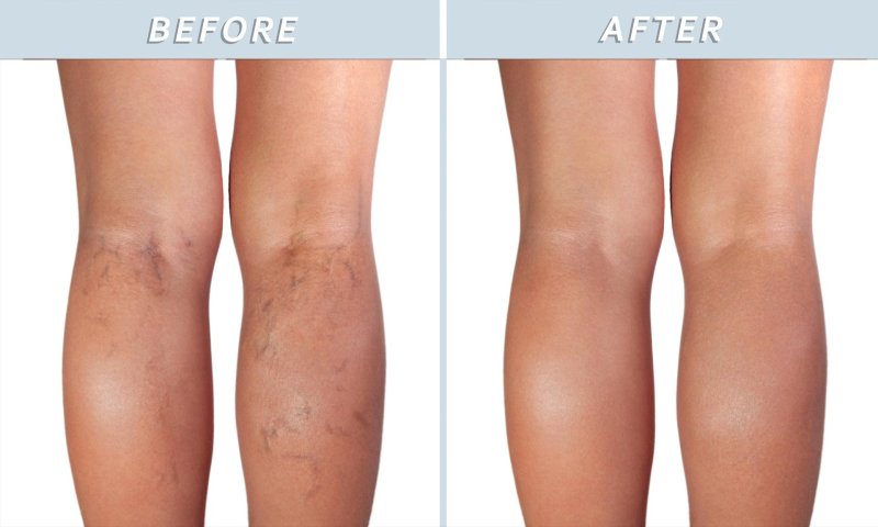 Склеротерапия ног варикоз