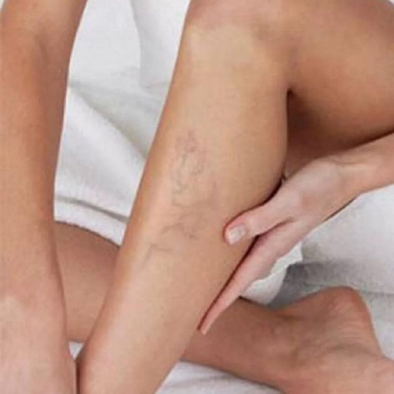 Варикоз телеангиэктазии