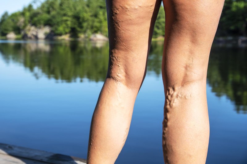 Varicose vein treatments