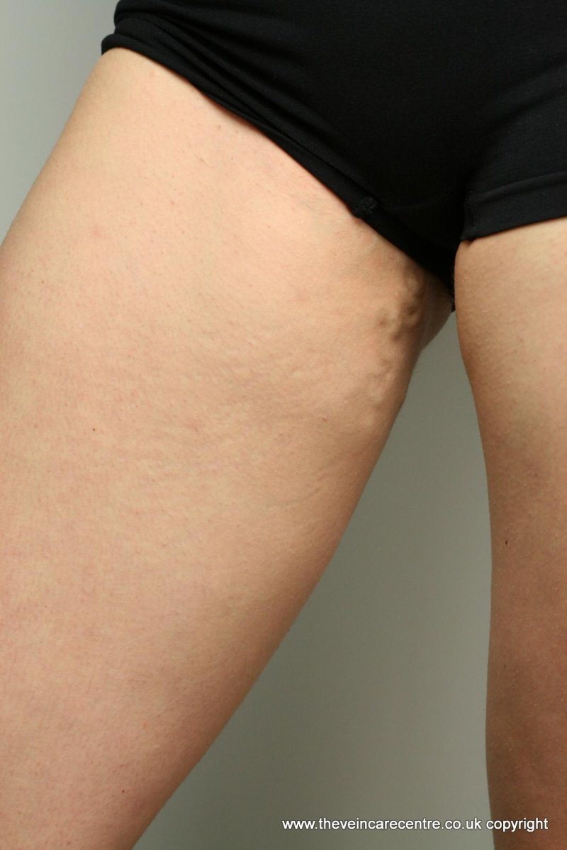 Варикозное расширение вен малого таза