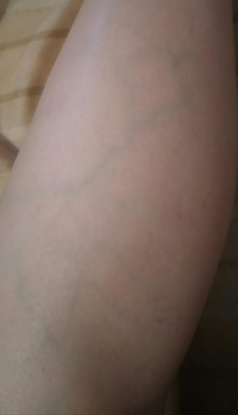 Видно вены на бедрах