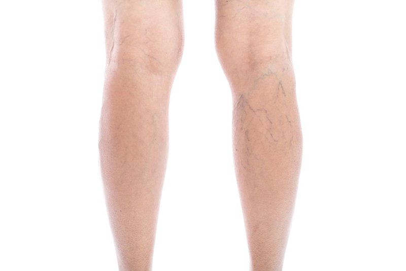 Ретикулярный варикоз на ногах