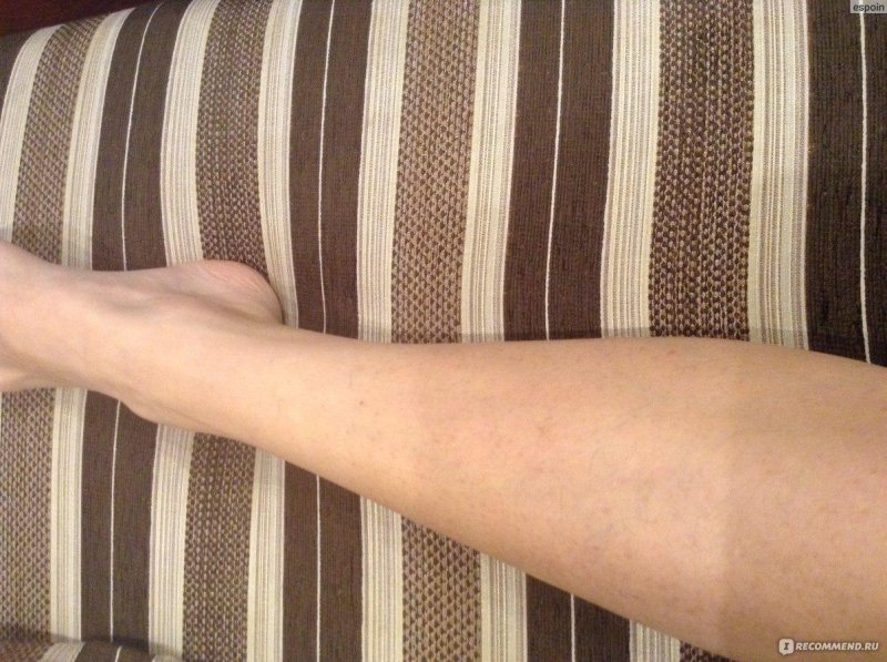 Варикозное расширение вен врв нижних конечностей