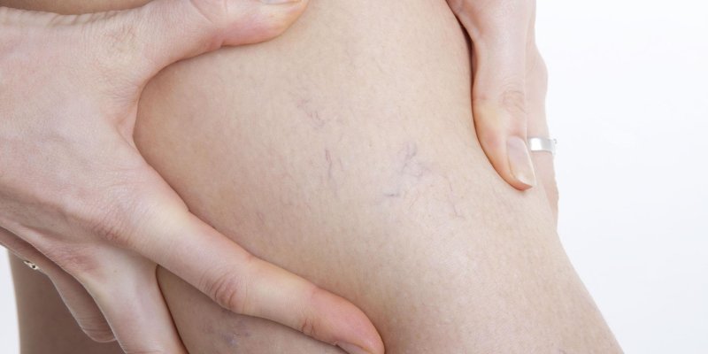 Варикоз вен сосудистые звёздочки