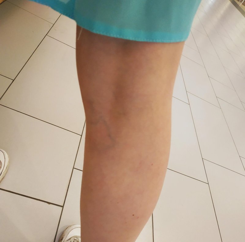 Вена на ногах