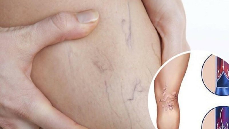 Варикозное расширение вен