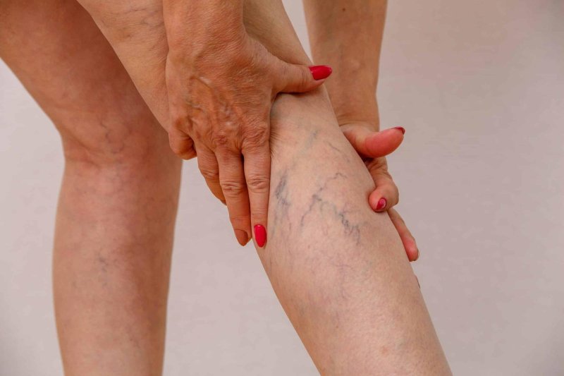 Целлюлит вены на ногах