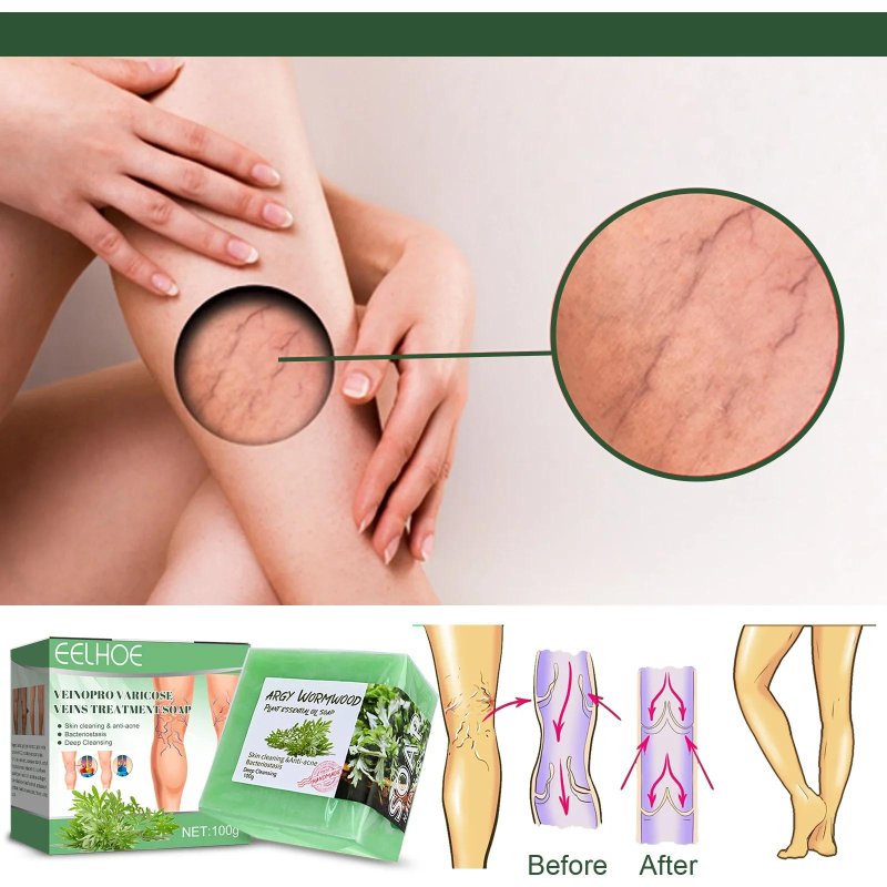 Крем для лечения варикозного расширения вен