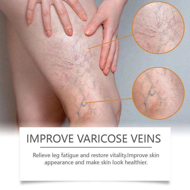 Varicose veins