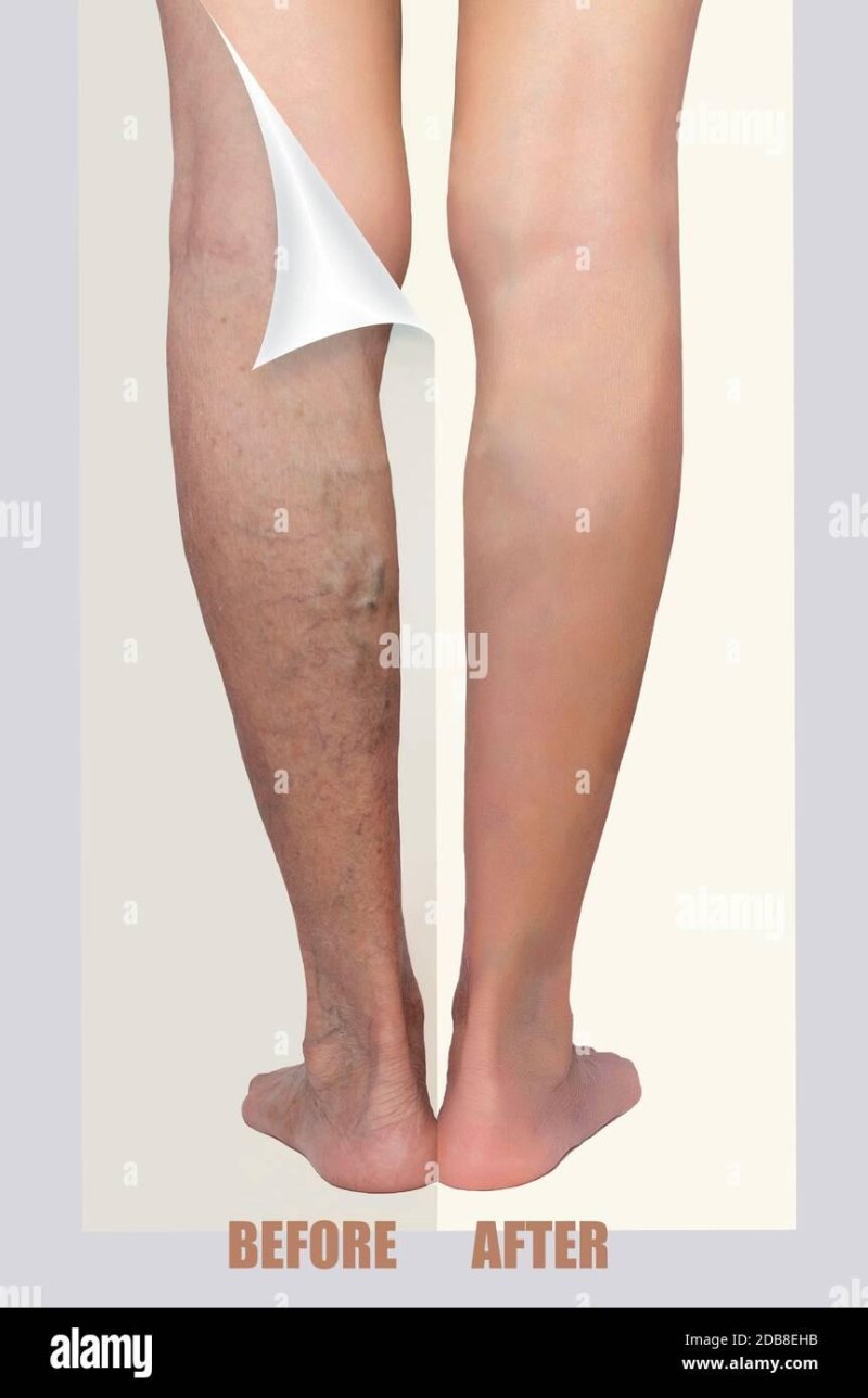 Варикоз на ногах