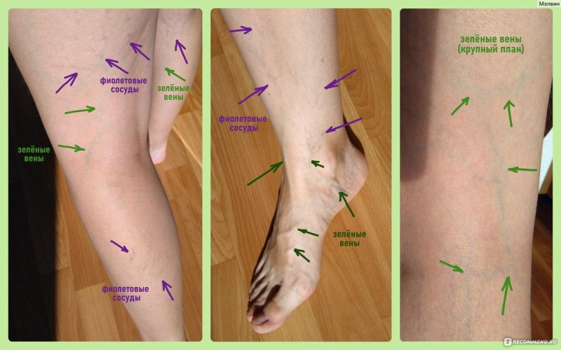 Выпирают вены на ногах