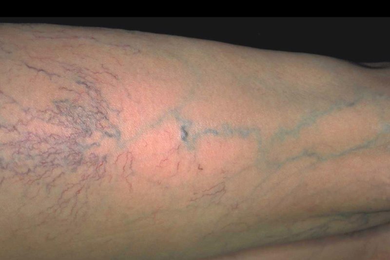 Тромбофлебит поверхностных вен голени