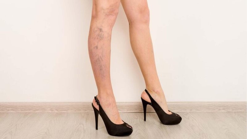 Варикоз на ногах у женщин