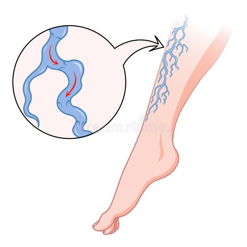 Варикозная вена