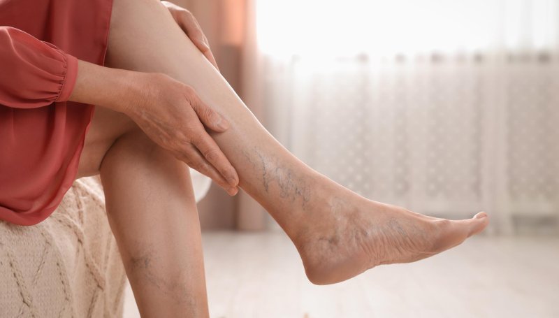 Understanding varicose veins