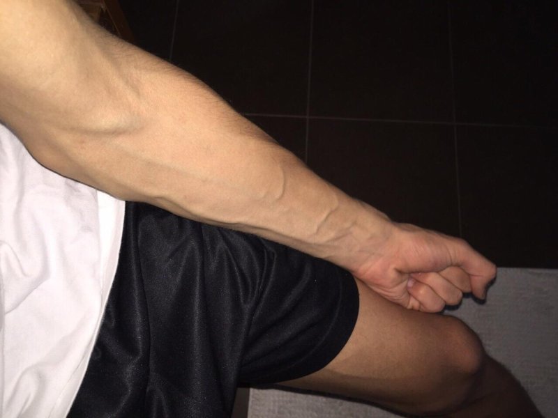 Венозность на предплечье