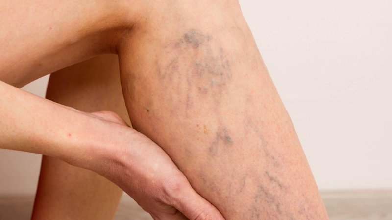 Варикозное расширение вен нижних конечностей