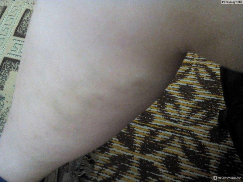 Вздулась вена на ноге