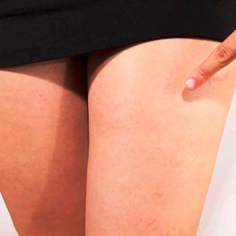 Начальная стадия варикоза