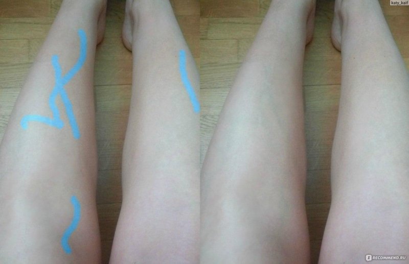 Тейпирование при варикозе голени