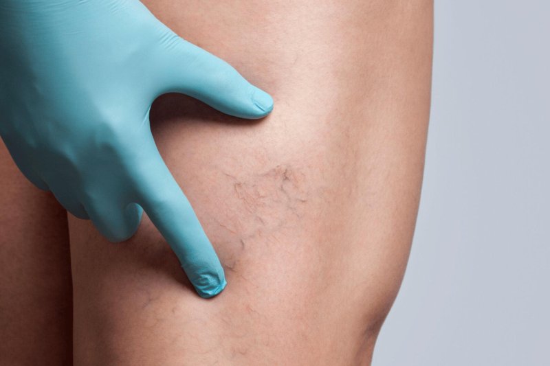 Сосудистая звездочка на ногах