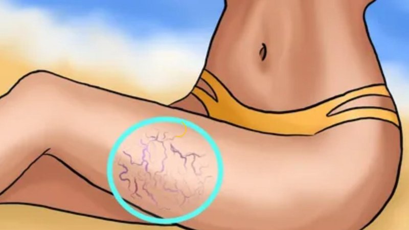 Ноги варикоз