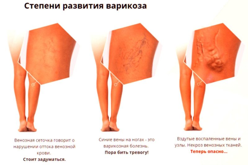 Варикозное расширение вен на ногах симптомы и лечение