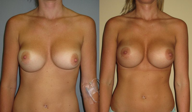 Увеличенная грудь без одежды
