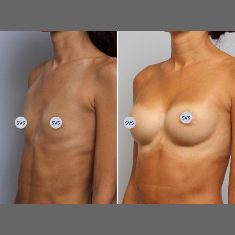 Грудь после увеличения