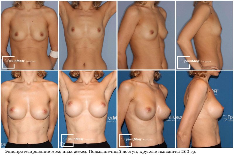 Грудь импланты