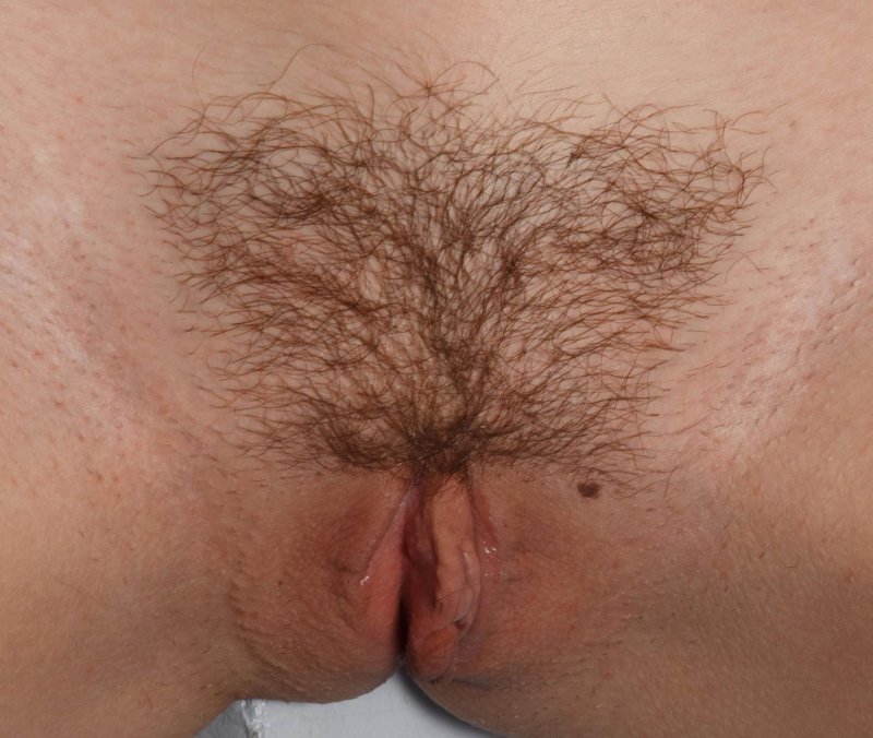 Волос на лобке
