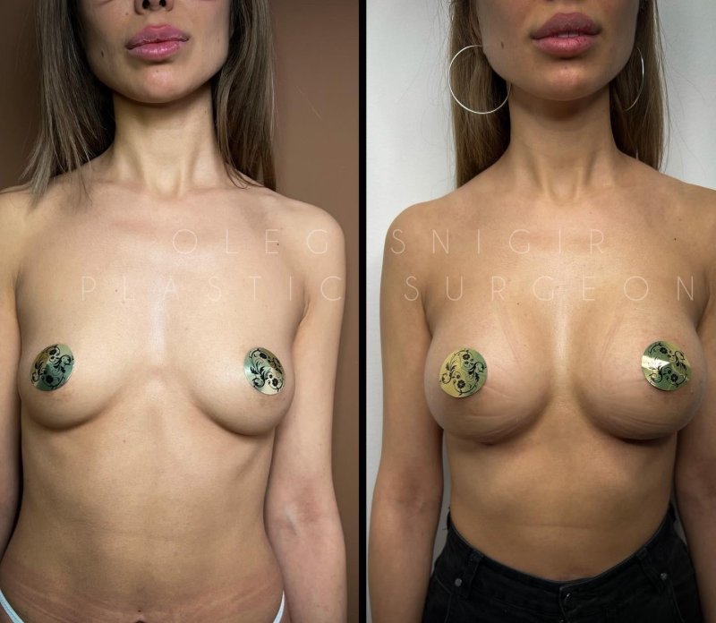 Пластика груди