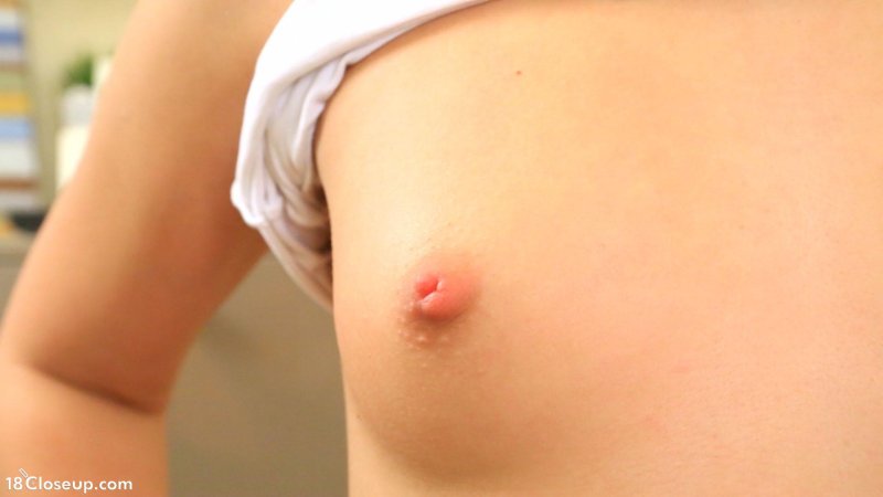 Белый прыщик на соске