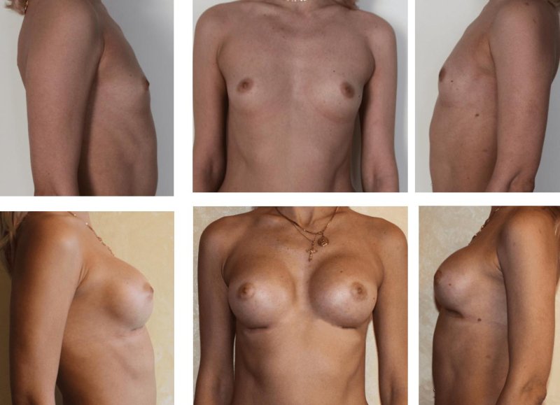 До и после увеличения груди